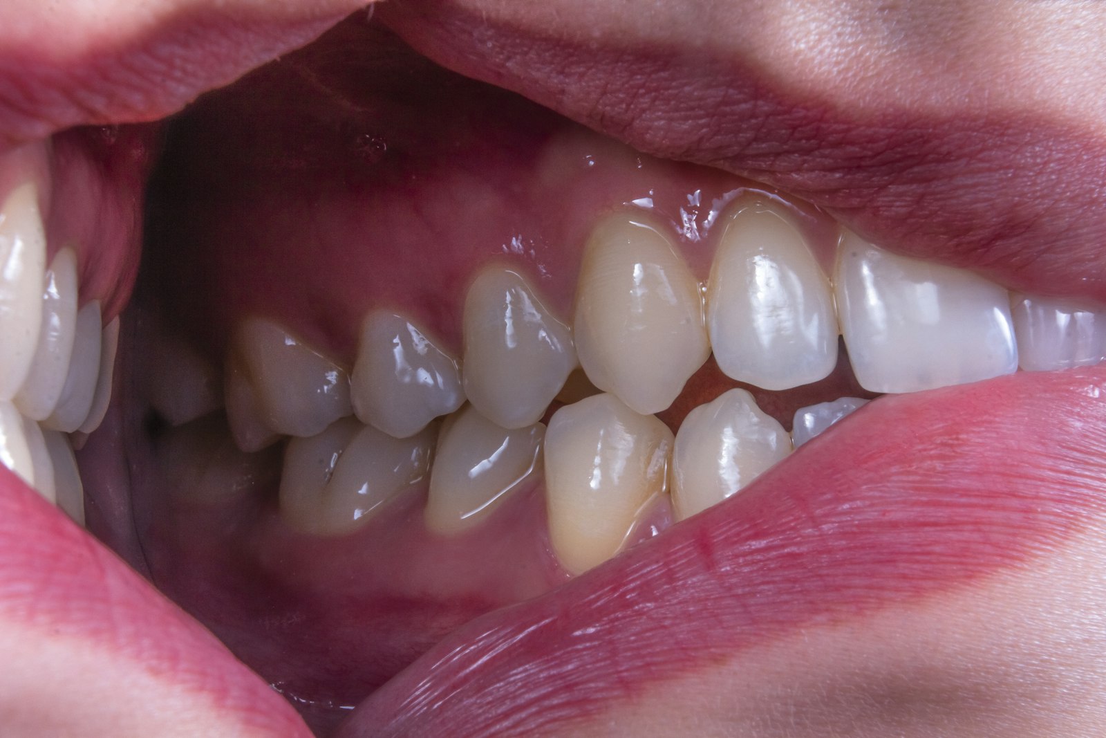 Chipped Front Tooth in Sydney: First Aid, Repair Options and What It Costs