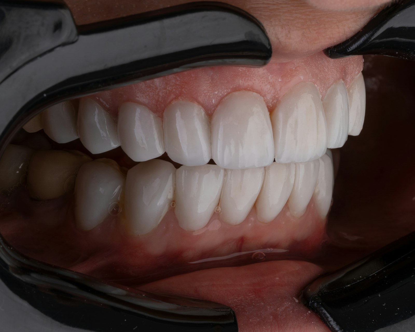 Full arch of fixed teeth fitted on same-day dental implants