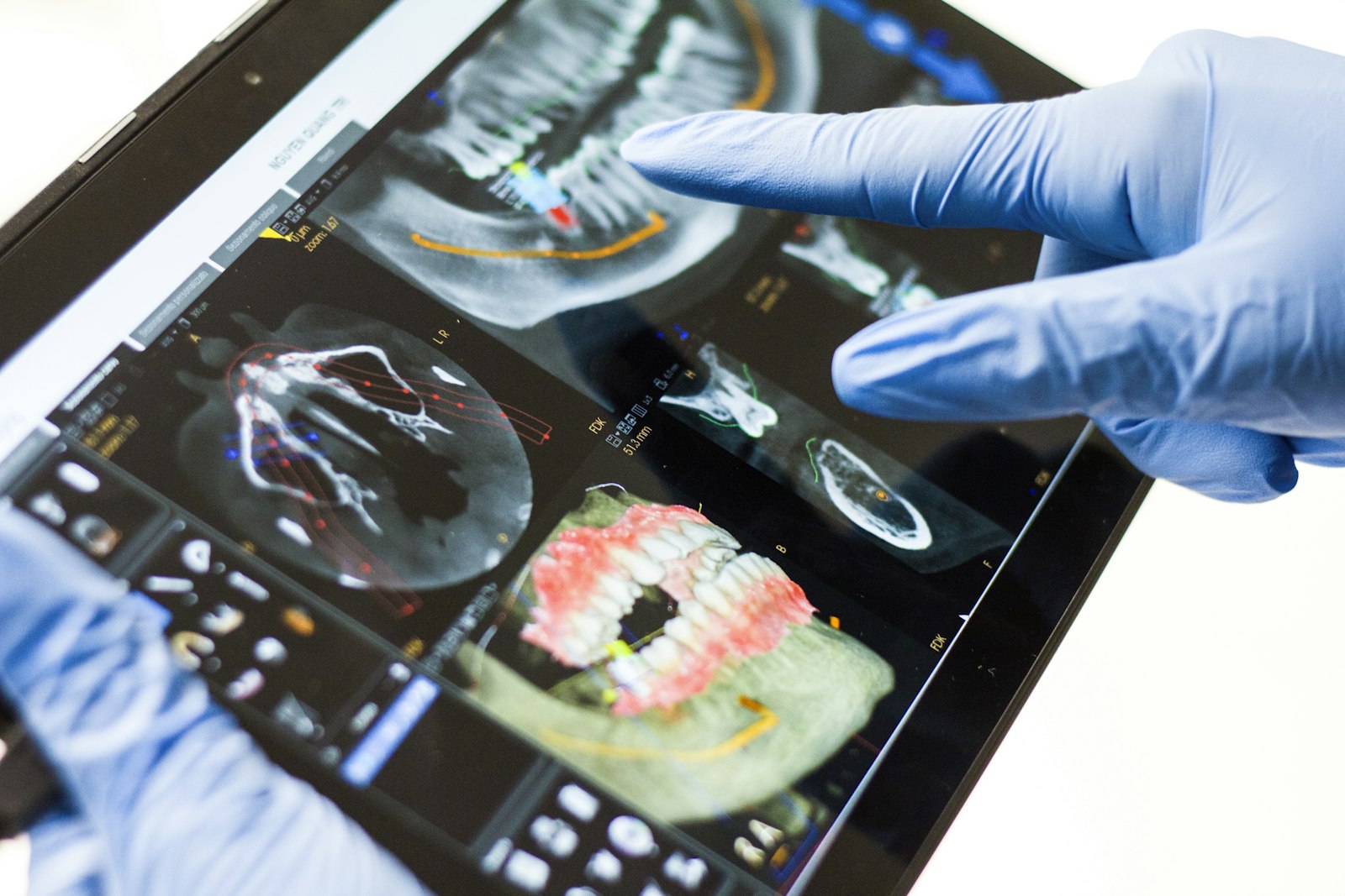 Dentist pointing at a dental scan on screen while explaining vital pulp therapy options to a patient