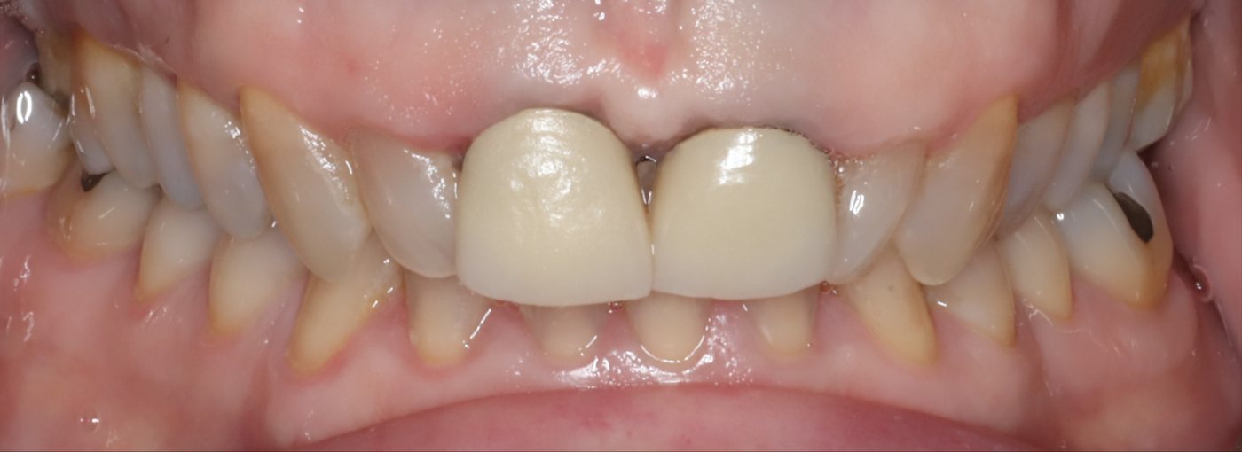 Upper teeth before treatment, with a dark line at the gum edge of an old crown