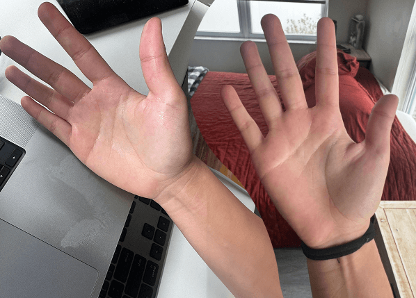 before & after comparison of hand sweat