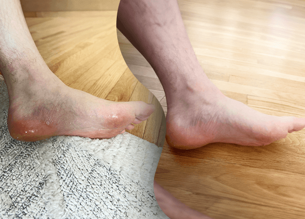 before & after comparison of feet sweat