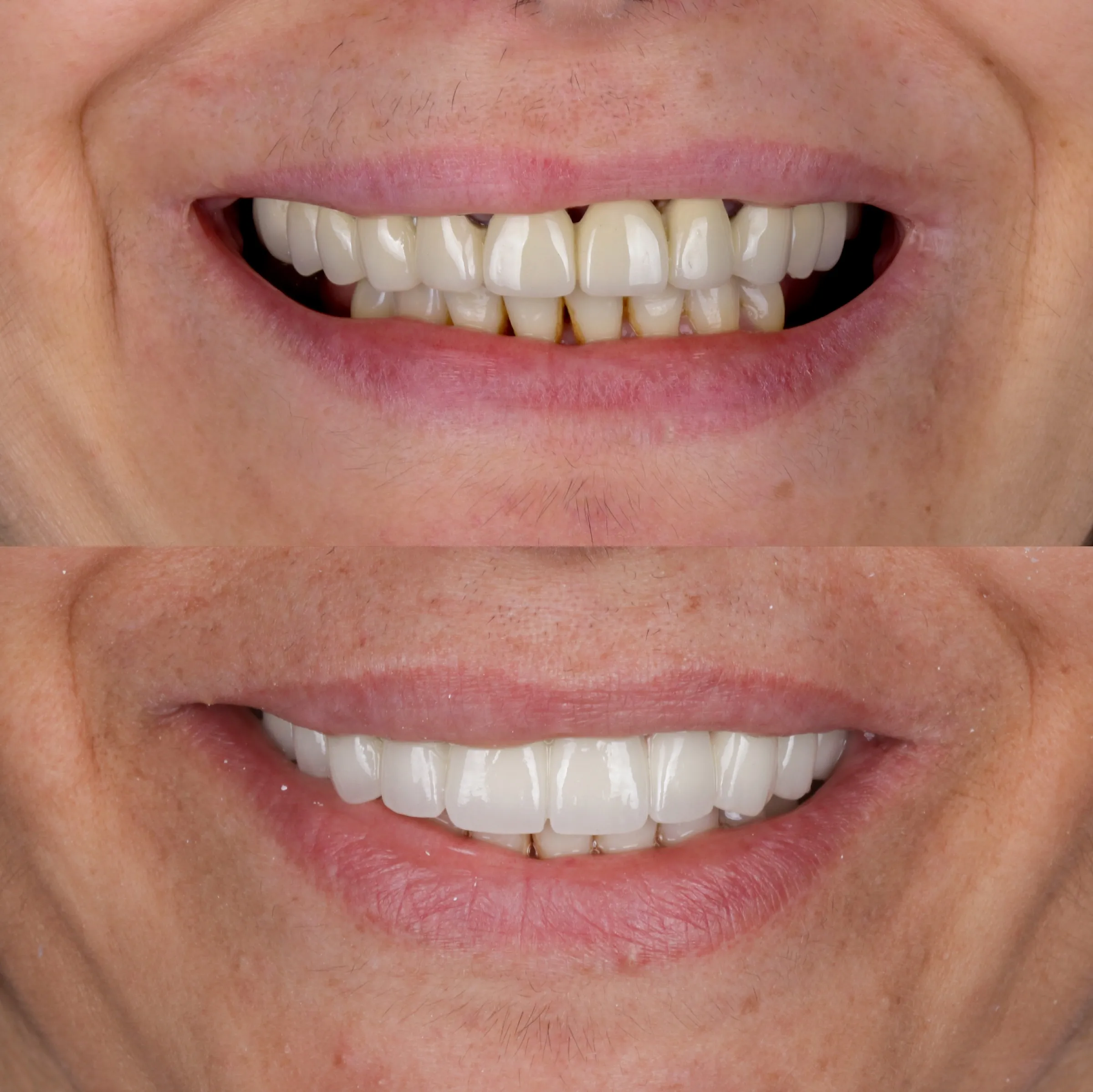 Confident patient smiling after full-mouth dental implant restoration at AVA Dental, showcasing natural-looking teeth and restored facial aesthetics.