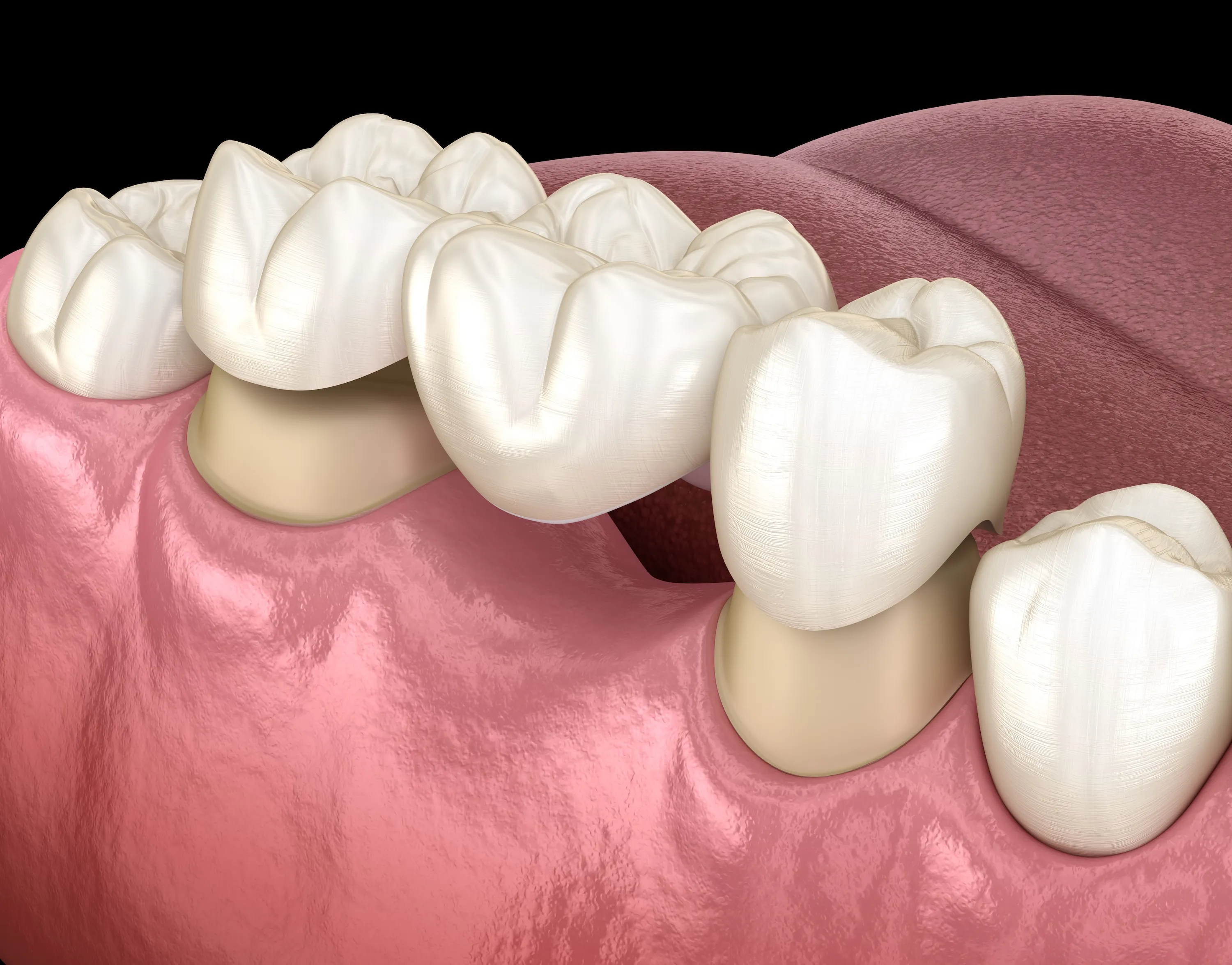 Digital illustration of dental bridge placement with crowns on adjacent teeth in the lower jaw.
