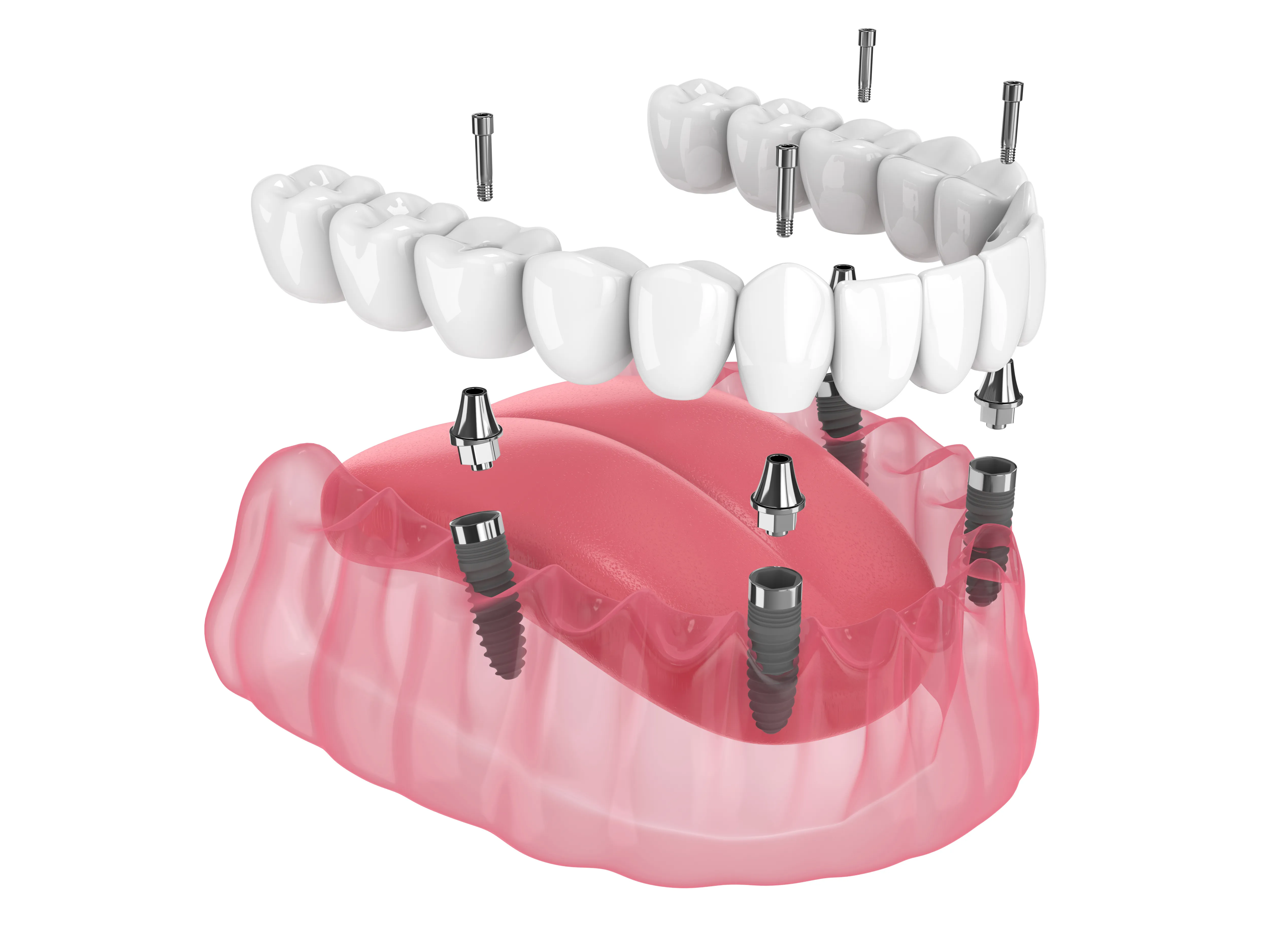 3D illustration of a lower jaw showing dental implants with abutments supporting two sets of artificial teeth.