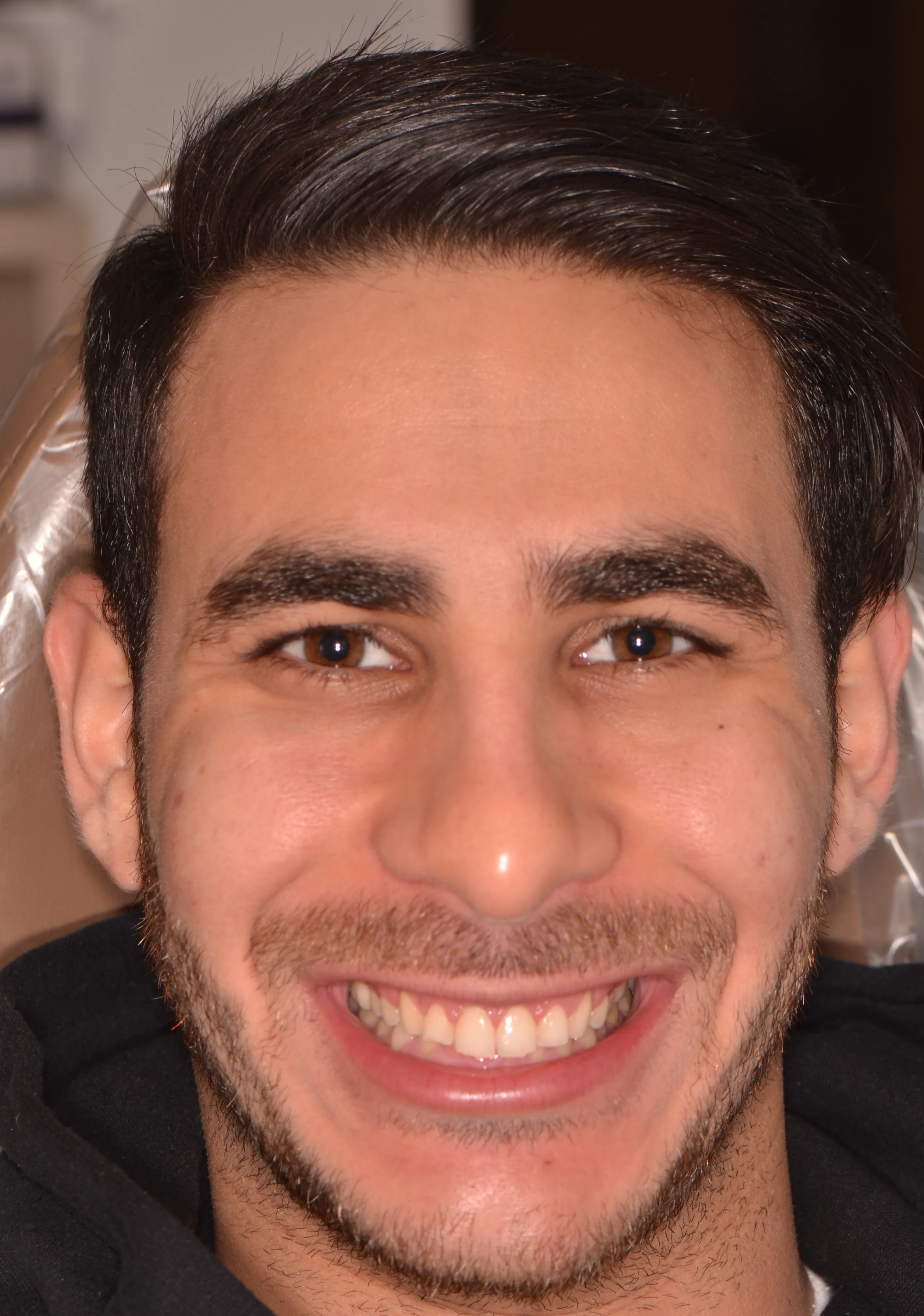 After: balanced gum line after esthetic crown lengthening by Dr. Rafik Dib