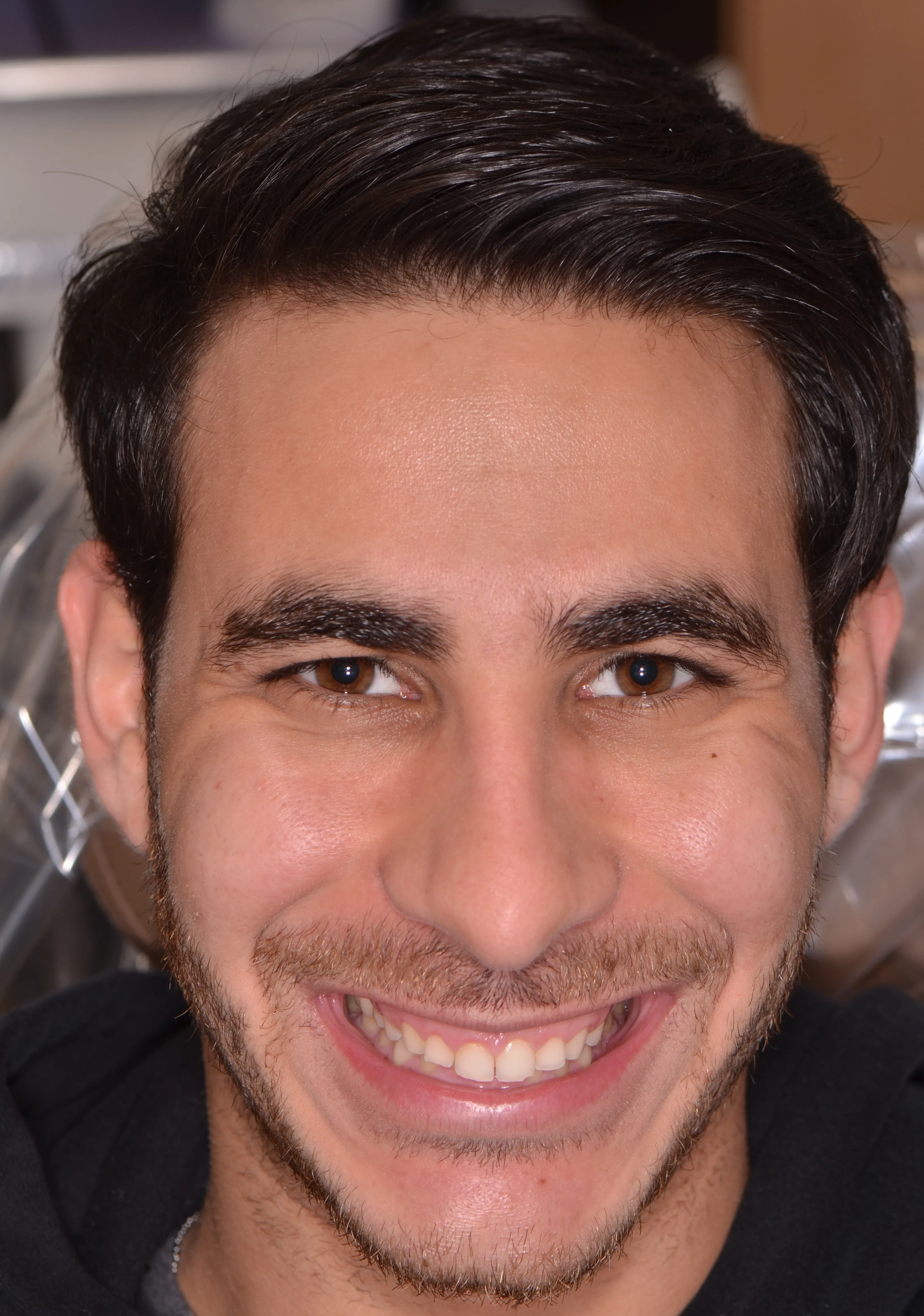 Before: gummy smile before esthetic crown lengthening at AVA Dental