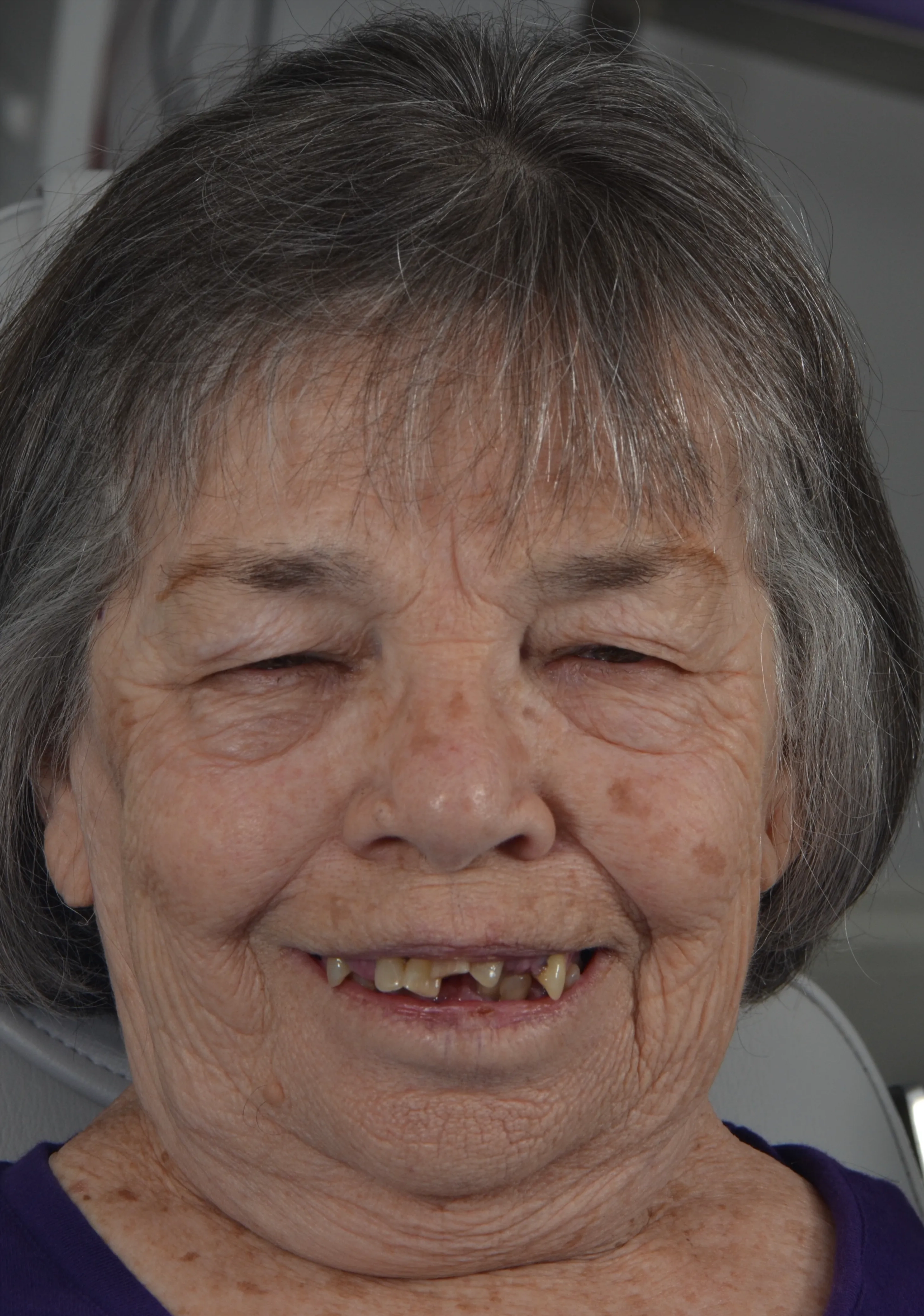 Before: gummy smile before esthetic crown lengthening at AVA Dental