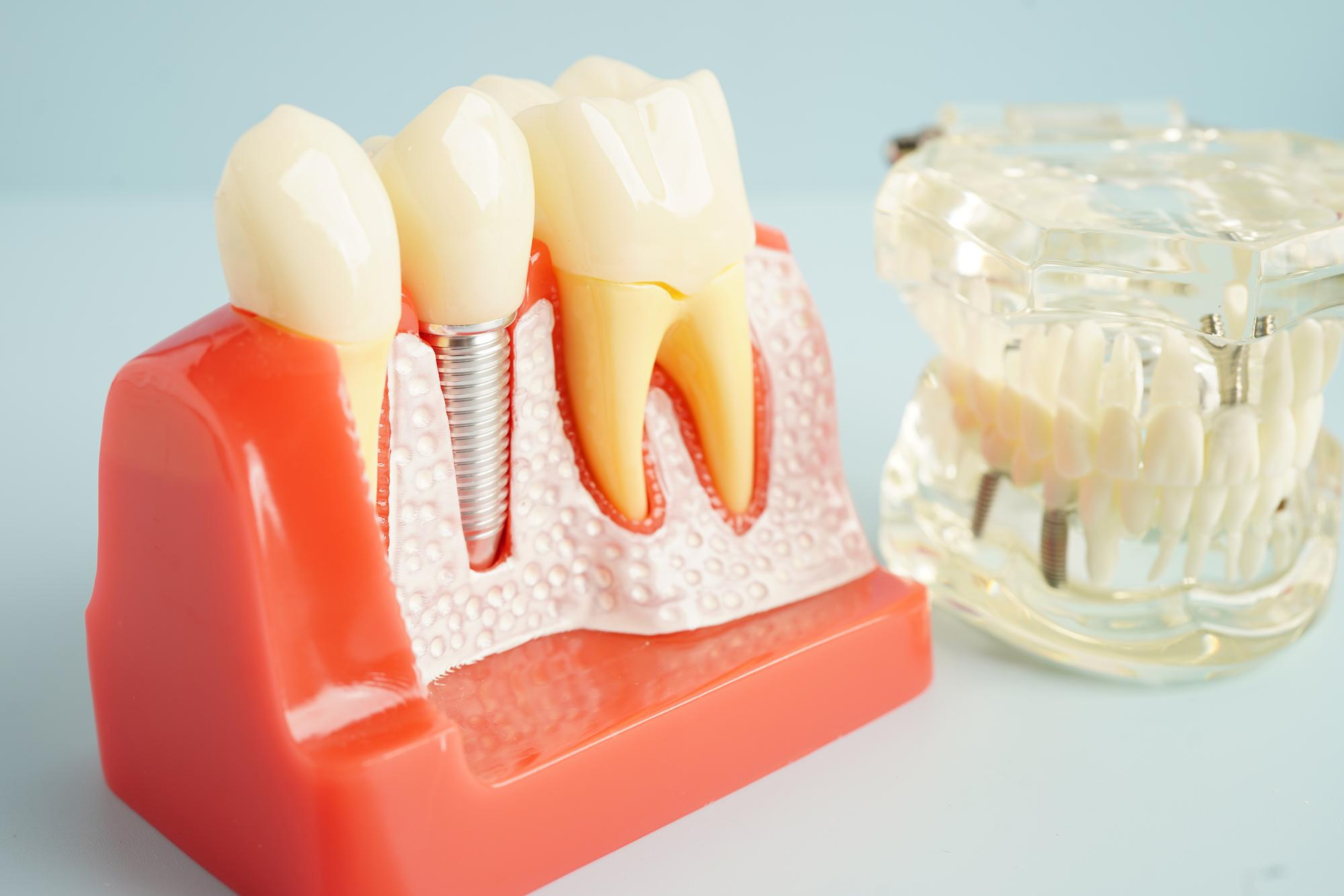 Why Wisdom Teeth Removal Protects Your Smile for Life