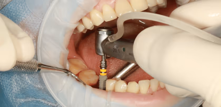 The dental implant procedure requires professionalism and precision