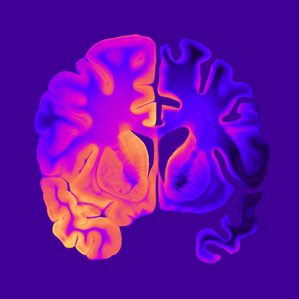 Alzheimer as seen in a brain image