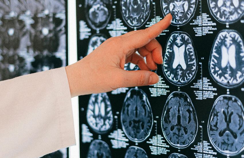 A hand in a white coat points to a series of brain MRI scans displayed on a dark background.