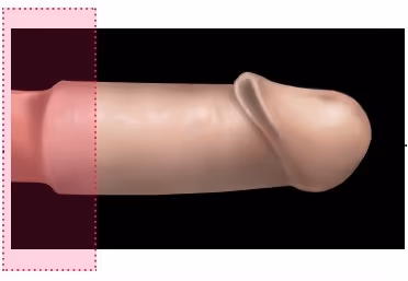 Step effect before surgery