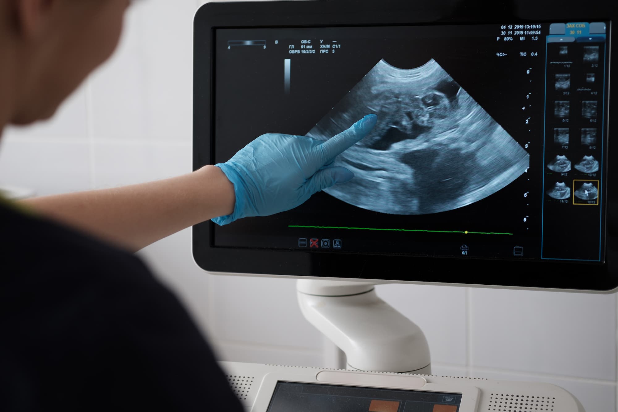 Medical professional wearing blue gloves pointing at a fetal ultrasound image on a monitor.
