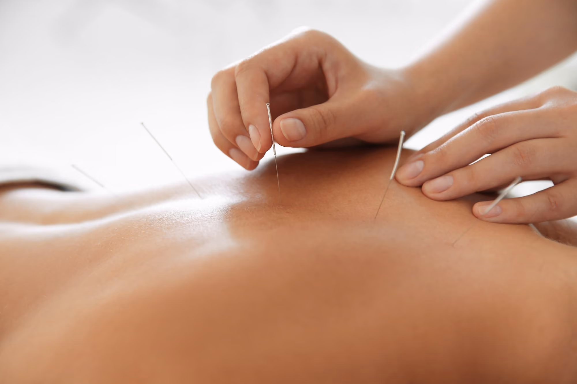 Close-up of hands inserting acupuncture needles into a person's bare back.