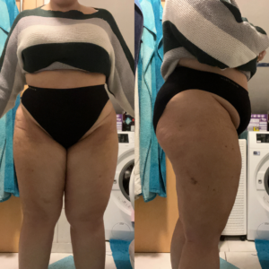 lipödem-beine-sarah-liposuktion