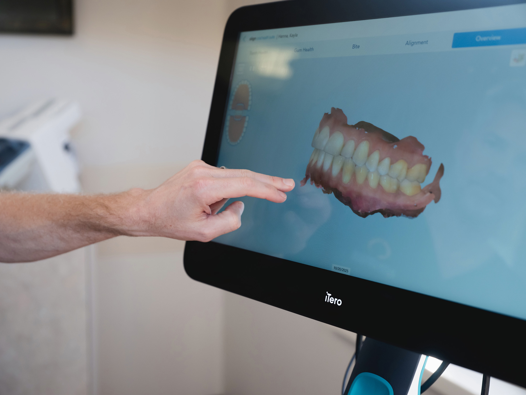 Hand pointing at a digital 3D rendering of teeth and gums on an iTero dental scanner screen.