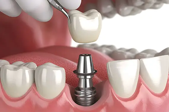 At Sunnybrook Dental we can restore your dental implant!