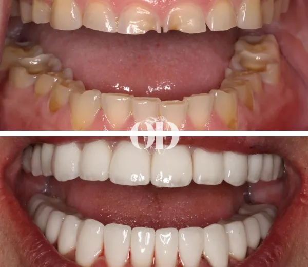 Veneer/Crown Full Mouth Rehab