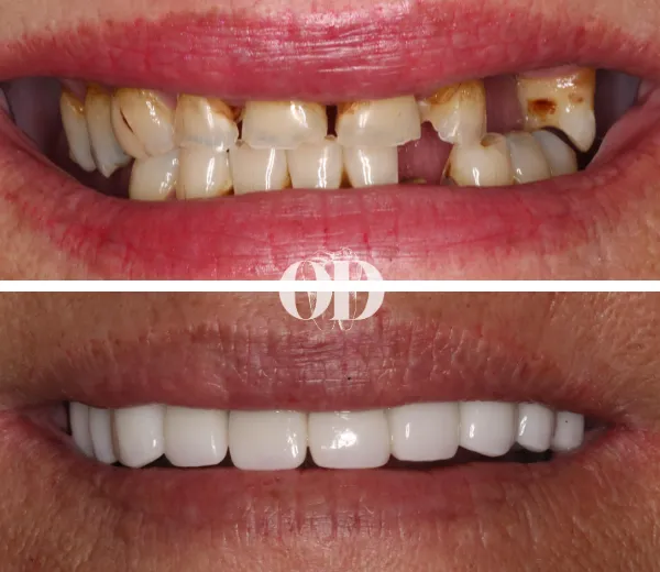 Upper Arch Crown and Bridge