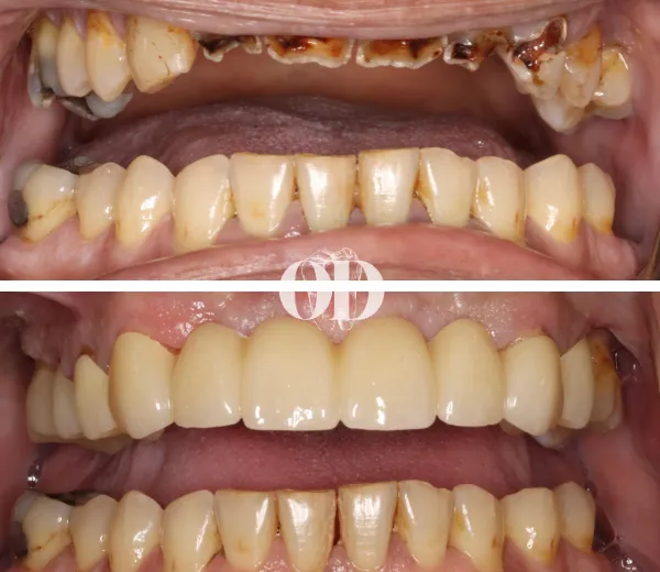 Upper Arch Crown and Bridge