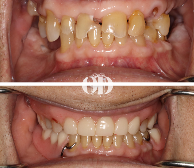 Upper and Lower Partial Dentures