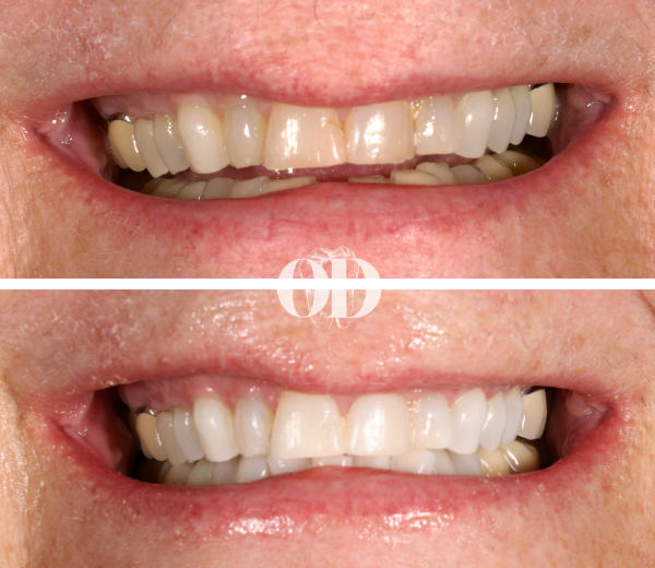 In-Office Whitening