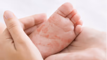 Adult hands gently holding a baby's foot with red allergy rash patches.