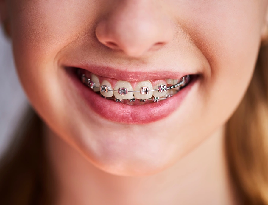 Close-up of a smiling person with pink-colored braces on their teeth.
