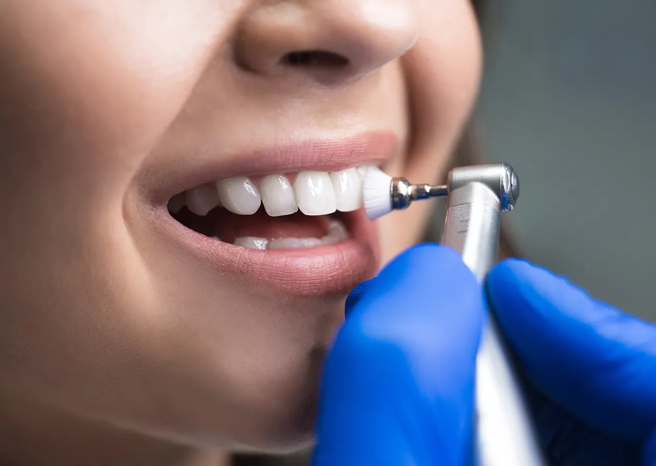 Close-up of a dentist using a rotating brush to clean a patient's upper front teeth.