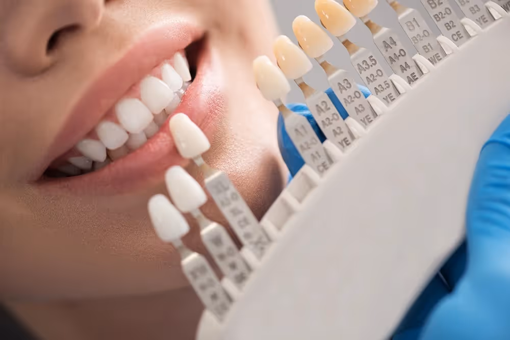 Close-up of a person smiling with white teeth, matched against a dental shade guide held by a gloved hand.