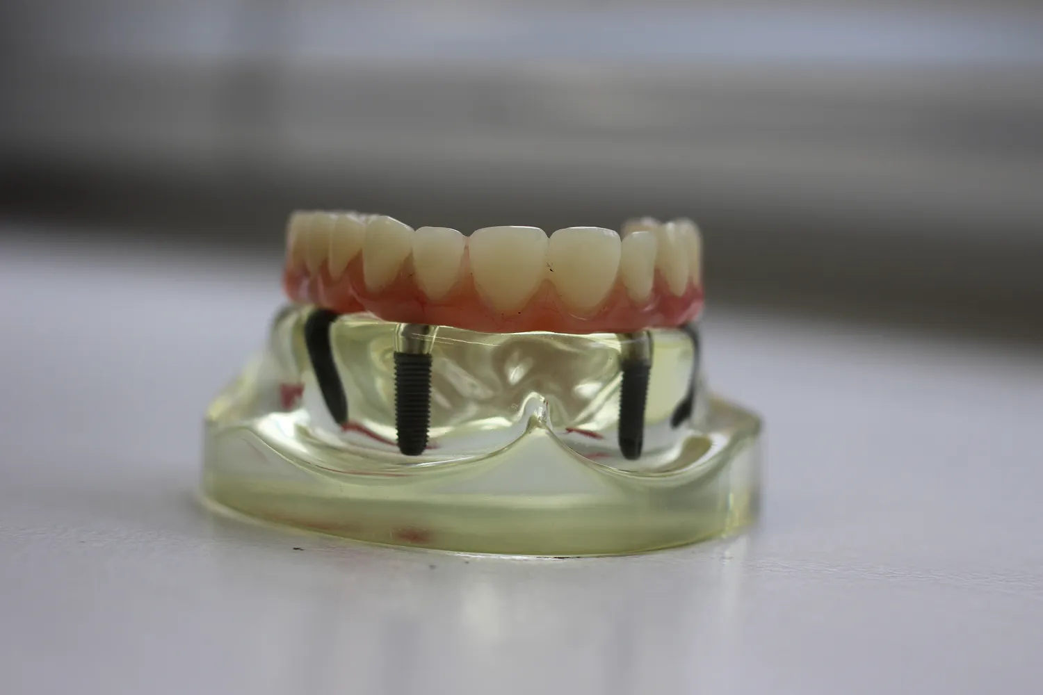 Model of dental implants with artificial teeth mounted on a transparent gum and jaw base.