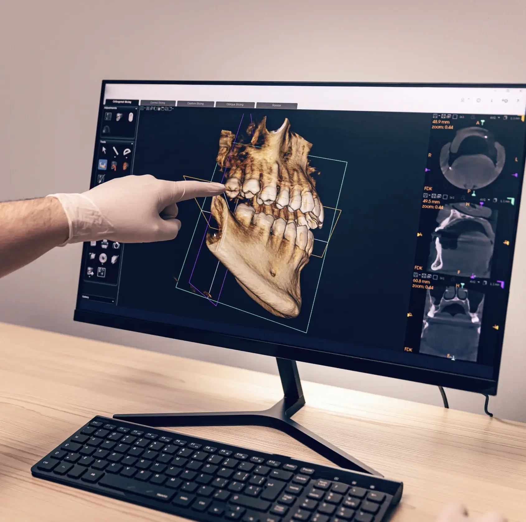 Gloved hand pointing at a 3D digital scan of a human jaw and teeth on a computer monitor.