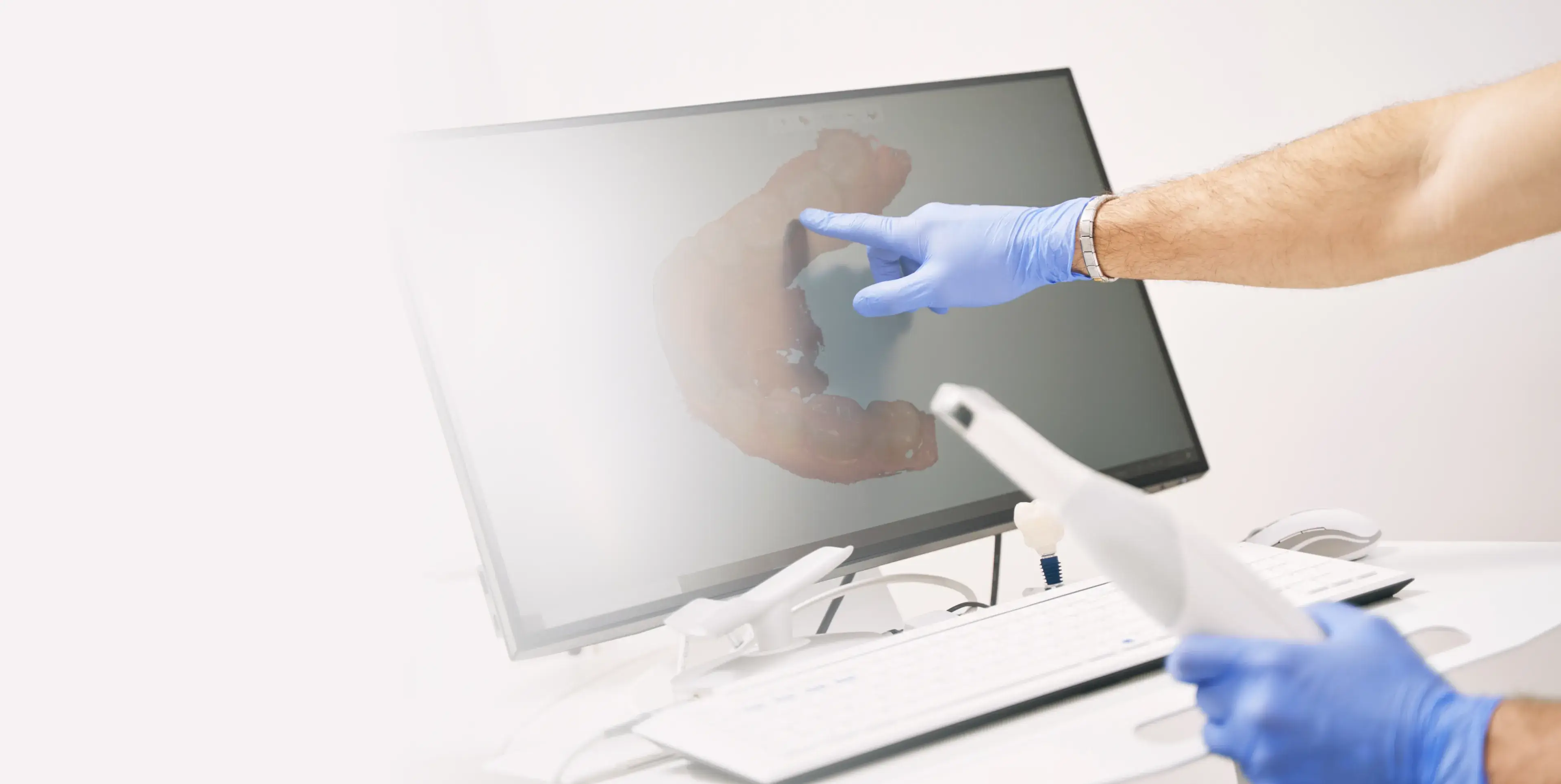 Person wearing blue gloves pointing at a dental 3D scan displayed on a computer screen while holding a dental scanner device.