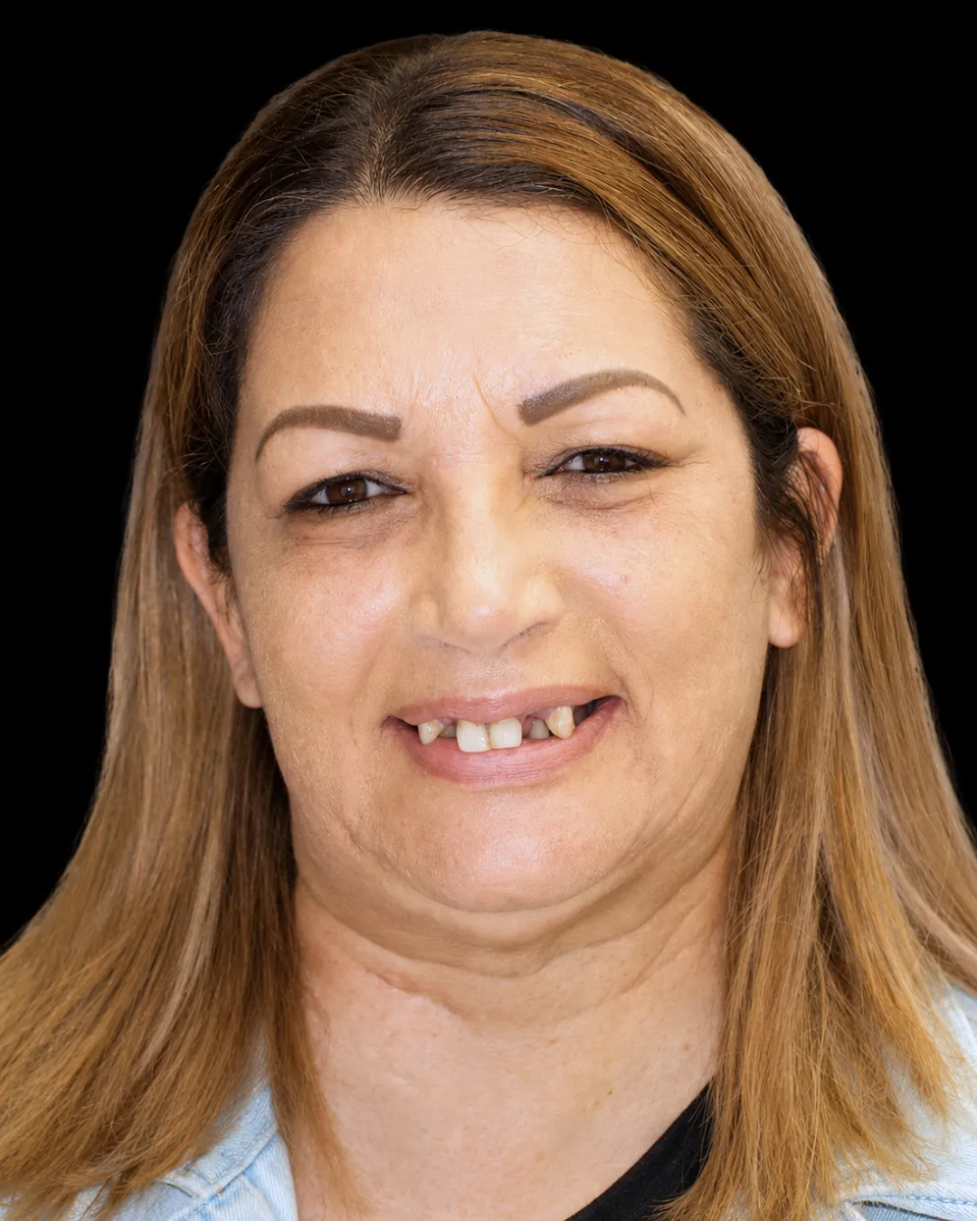 Patient before treatment, with only a few failing teeth remaining