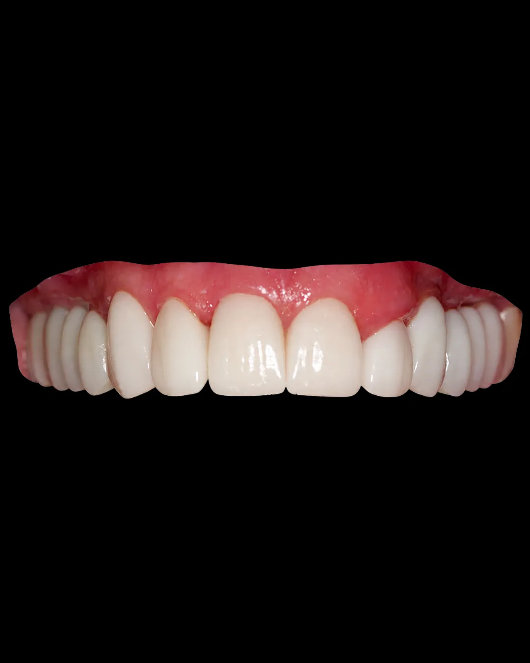 The same patient after bone grafting, implants, an upper arch restoration and veneers made in the practice's own laboratory