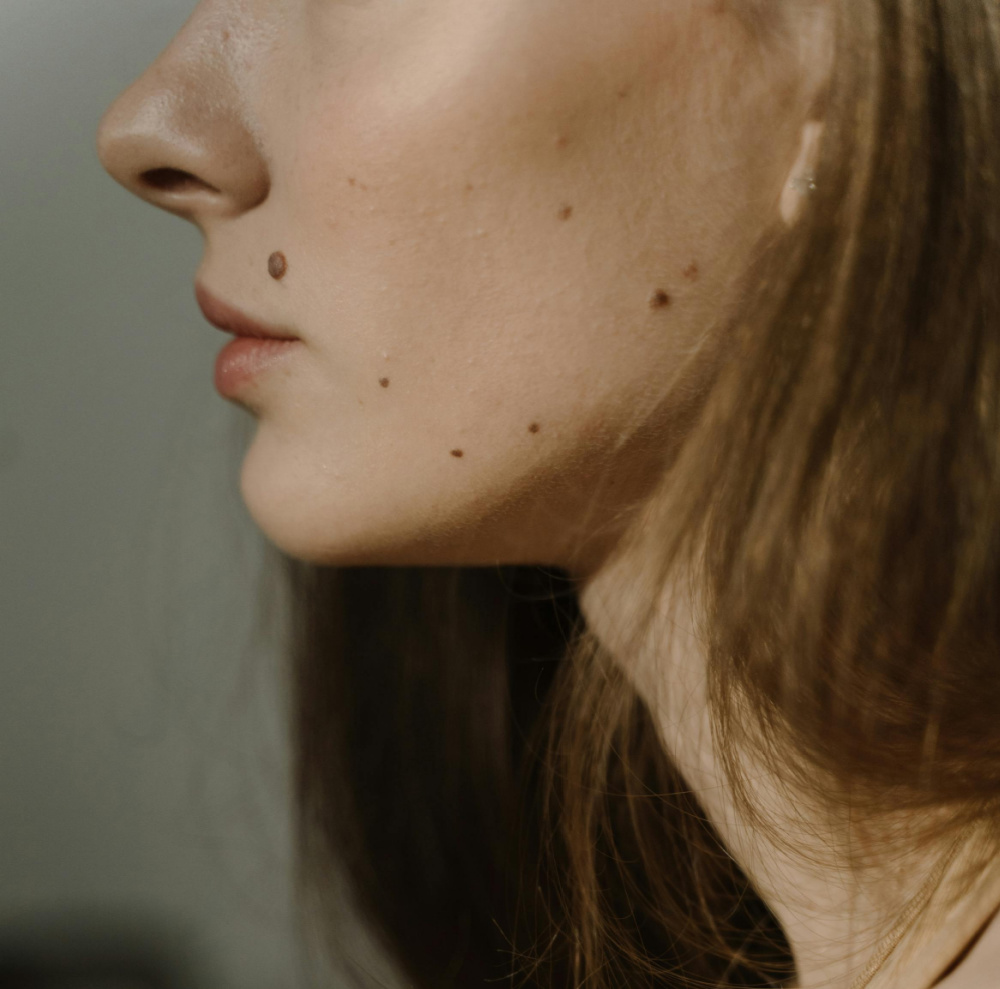 Close-up side profile of a woman’s face showing multiple moles on her cheek and jawline.