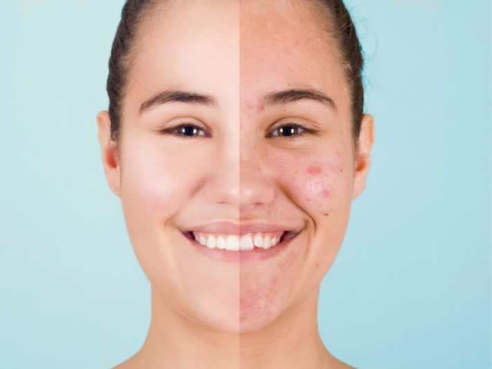 Acne Treatment | Aesthetics Treatment | Magnolia Functional Wellness