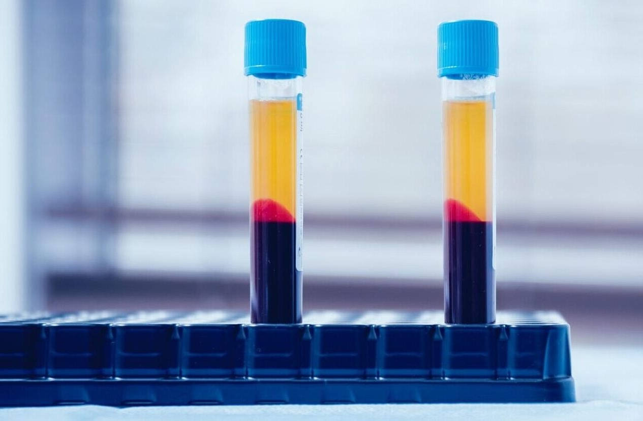 PRP Hair Restoration Southlake TX | EmCyte PurePRP | Magnolia Functional Wellness