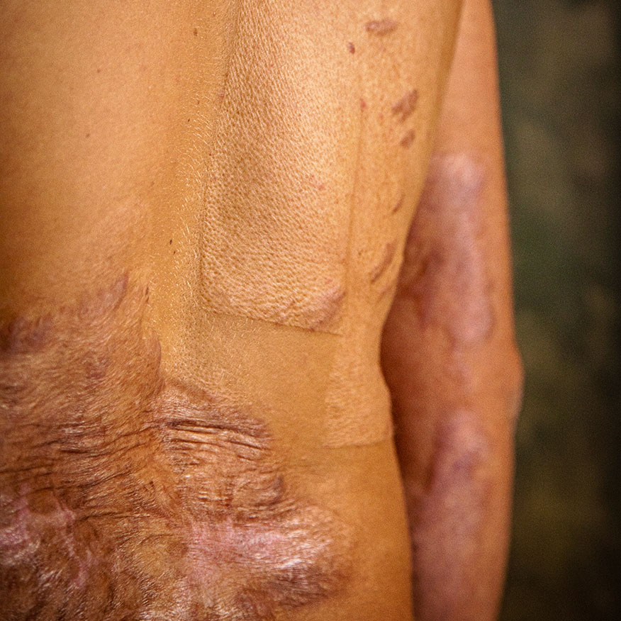 I segni del mestiere, Campagna sociale. Pelle con cicatrici e zone di pelle rigenerata con texture variabile.