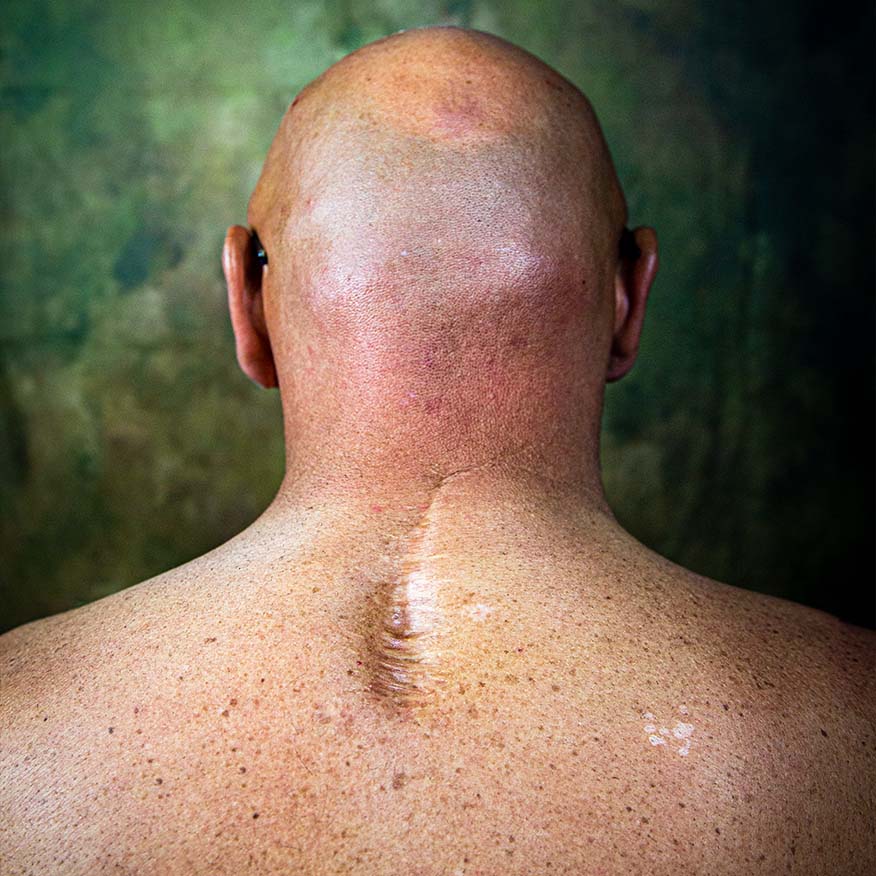 I segni del mestiere, Campagna sociale. Vista posteriore della testa calva e delle spalle di una persona con una cicatrice lunga e lineare sul collo.