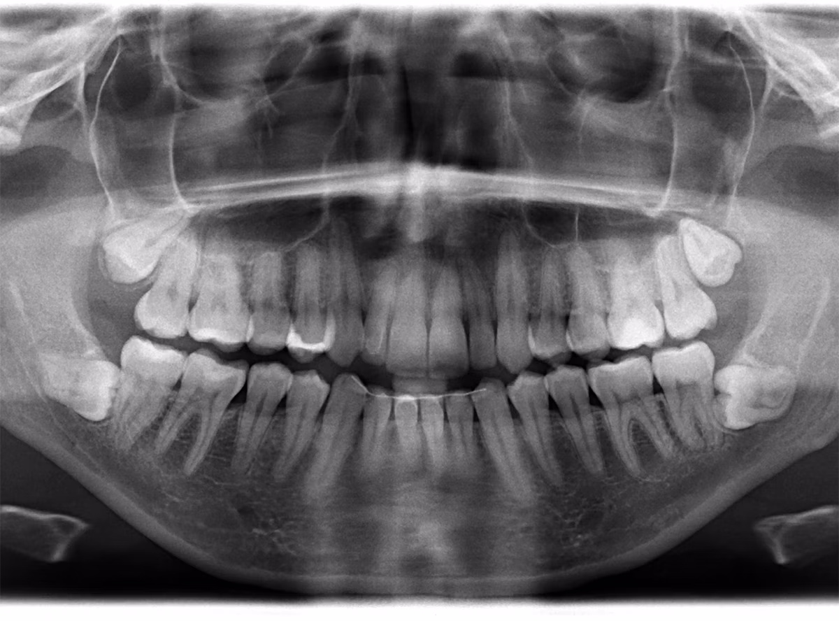 Panoramic dental X-ray showing a full set of adult teeth including developing wisdom teeth.