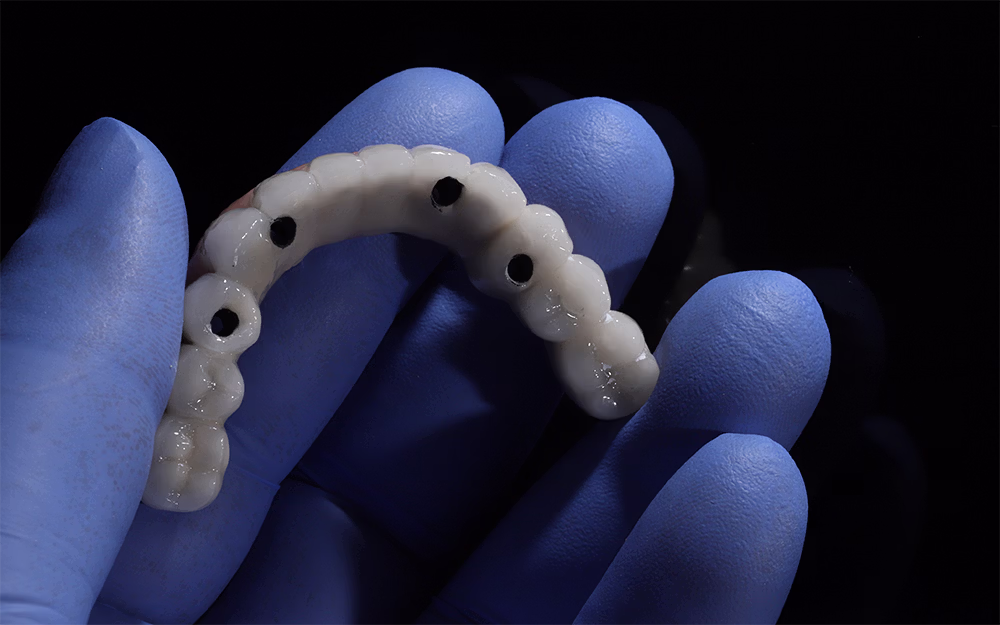 Blue-gloved hand holding a all-on-4 dental implant model.
