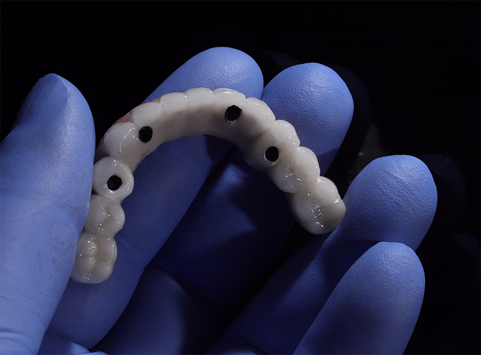 Close-up of a gloved hand holding an all-on-4 dental implant.