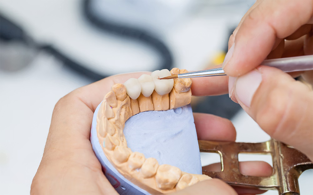 Hands holding a dental mold while using a small brush to apply or adjust dental crowns on the upper teeth.