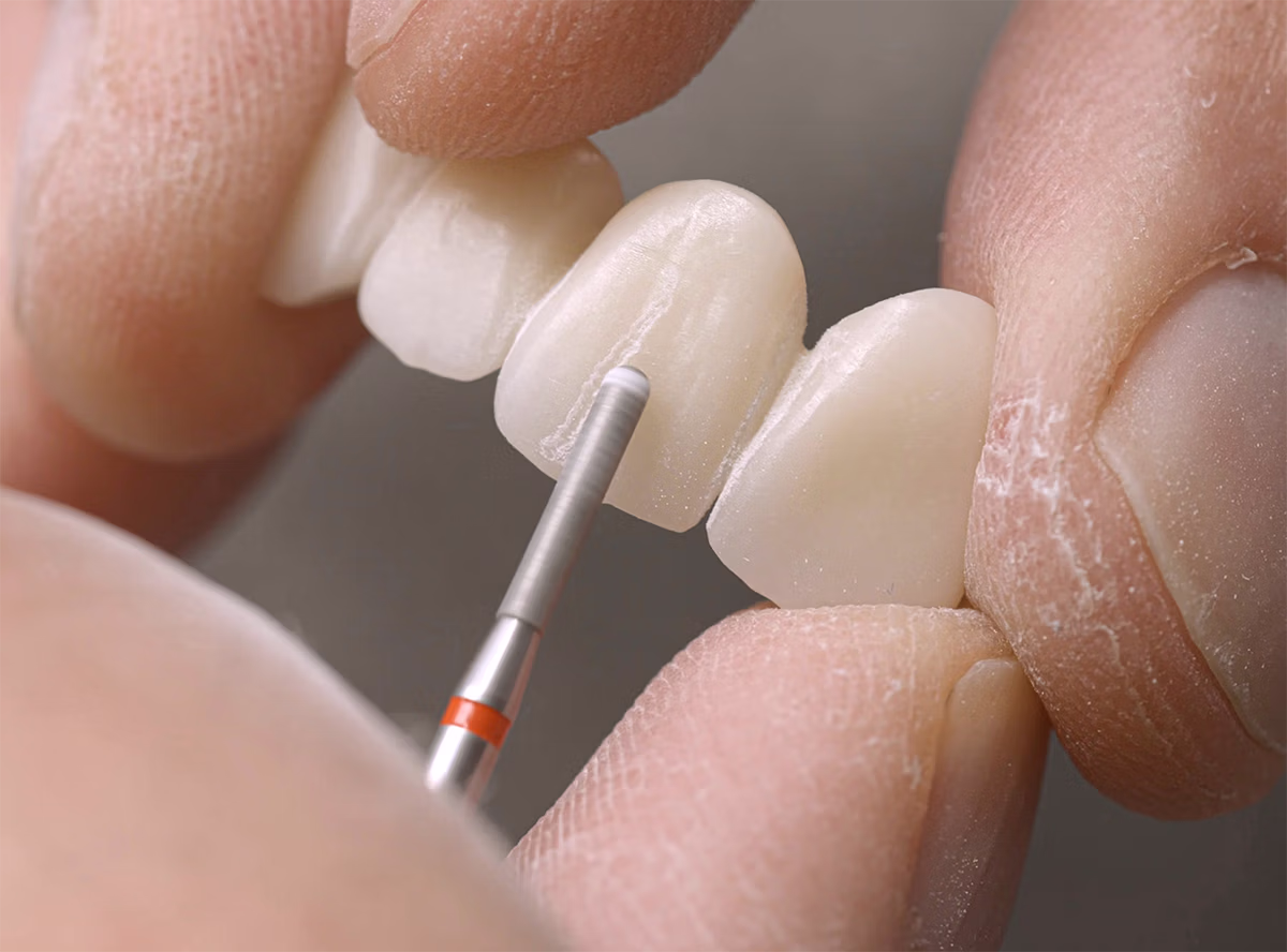 Close-up of hands holding dental veneers while smoothing a veneer with a dental polishing tool.