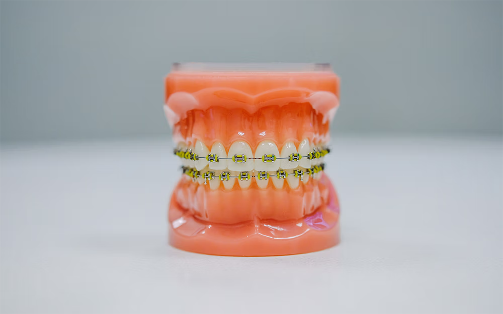 Dental model showing teeth with yellow braces attached.
