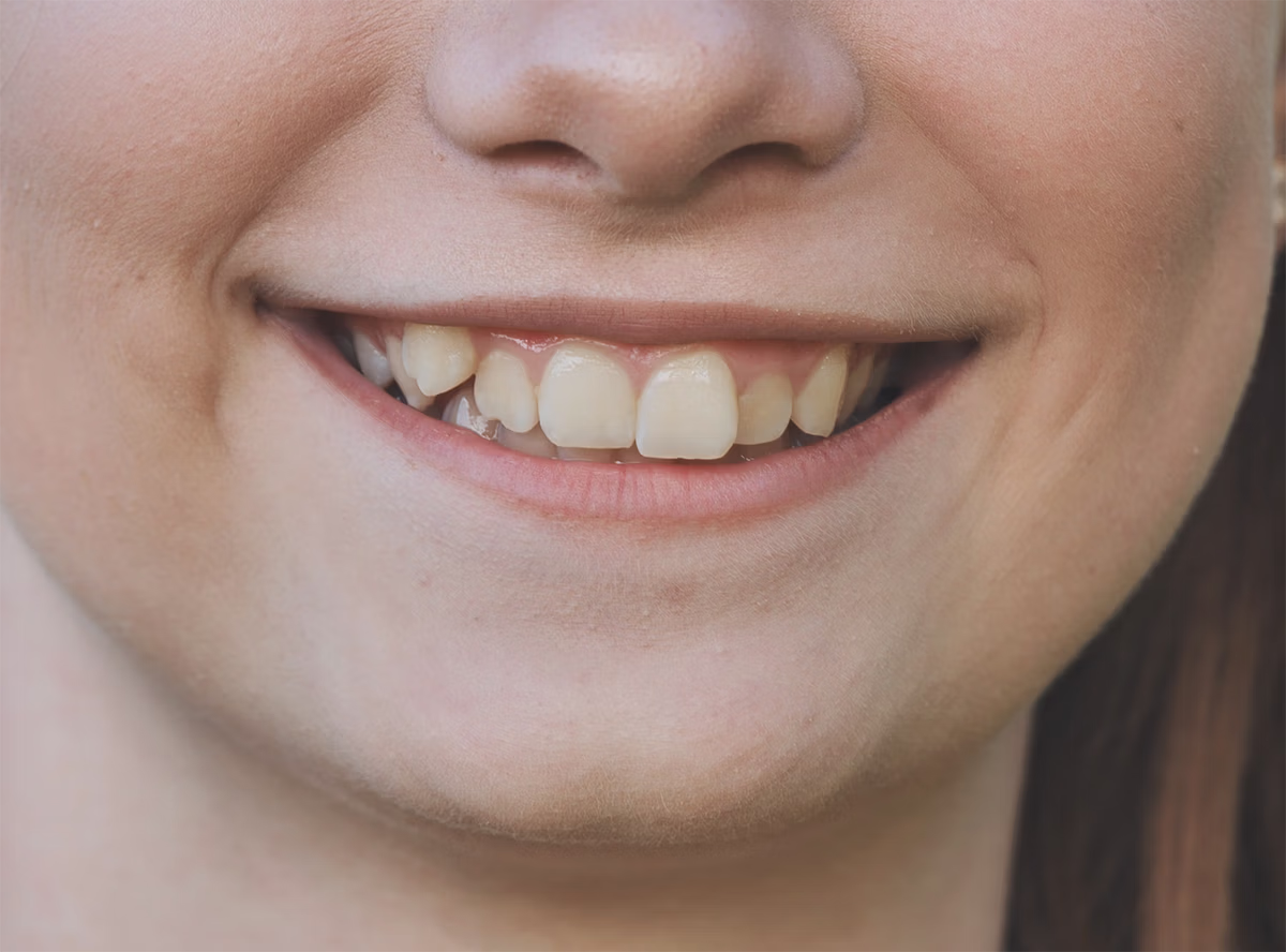 Close-up of a person smiling showing slightly misaligned upper front teeth.