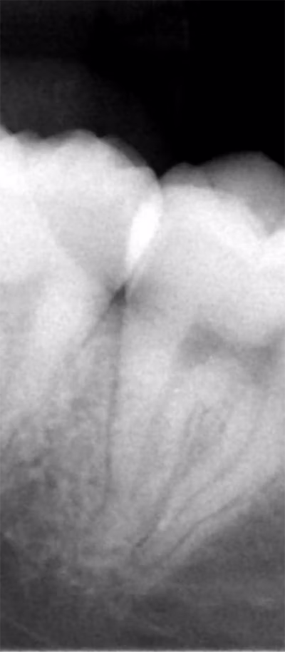 X-ray image showing two adjacent molar teeth that are impacted.