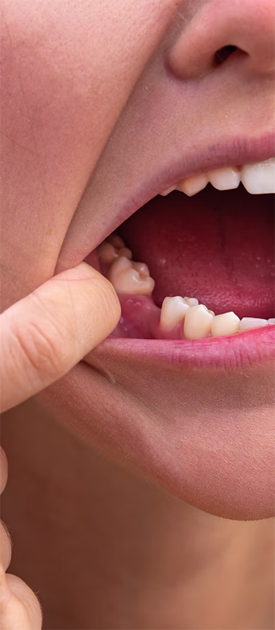 Close-up of a person pulling down their lower lip to show missing tooth.